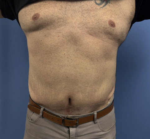 Abdominoplasty | After Male Tummy Tuck